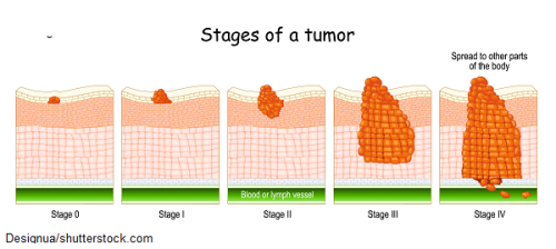 stages-tumor-nursing-nclex.png