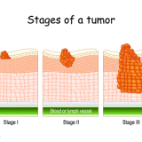 stages-tumor-nursing-nclex