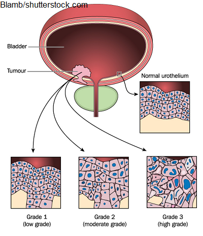 tumor-grading-staging.png